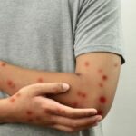 Mpox continua a representar emergência de saúde pública internacional, declara OMS