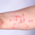 SP registra 44 casos confirmados de mpox em 2026